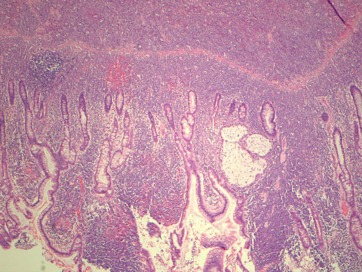 Small bowel myeloid sarcoma (H&E 40X)